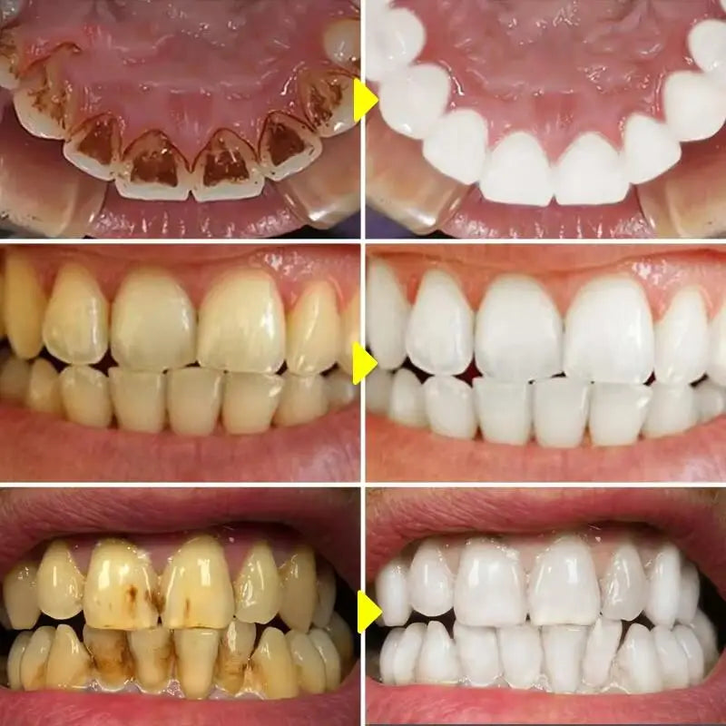 Super tooth whitening Activated charcoal