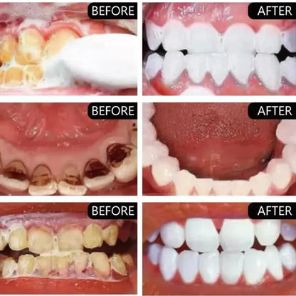 Super tooth whitening Activated charcoal